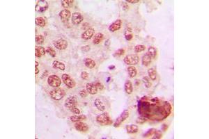 Immunohistochemical analysis of GRK5 staining in human lung cancer formalin fixed paraffin embedded tissue section. (GRK5 antibody  (Center))