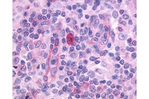 Anti-CD97 antibody IHC of human Lymph Node, Hodgkins Lymphoma. (CD97 antibody  (N-Term))