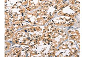 The image on the left is immunohistochemistry of paraffin-embedded Human thyroid cancer tissue using ABIN7190849(GPR182 Antibody) at dilution 1/30, on the right is treated with synthetic peptide. (G Protein-Coupled Receptor 182 antibody)