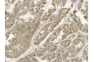 ABIN6258306 and ABIN6274290 at 1/100 staining human renal cell carcinoma by IHC-P. (PTTG1 antibody  (C-Term))
