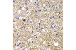 Immunohistochemistry of paraffin-embedded human brain cancer using CDK6 antibody (ABIN1871736) at dilution of 1:100 (40x lens).
