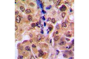 Immunohistochemical analysis of RAD52B staining in human breast cancer formalin fixed paraffin embedded tissue section. (RDM1 antibody  (Center))