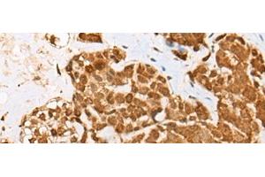 Immunohistochemistry of paraffin-embedded Human thyroid cancer tissue using ATN1 Polyclonal Antibody at dilution of 1:50(x200) (Atrophin 1 antibody)