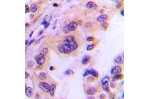 Immunohistochemical analysis of Translin staining in human lung cancer formalin fixed paraffin embedded tissue section. (Translin antibody  (Center))