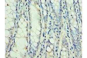 Immunohistochemistry of paraffin-embedded human colon cancer using ABIN7169764 at dilution of 1:100 (SSNA1 antibody  (AA 1-119))