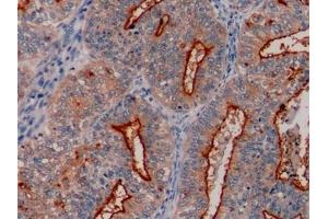 Detection of MUC1 in Human Endometrial cancer Tissue using Polyclonal Antibody to Mucin 1 (MUC1) (MUC1 antibody  (AA 1034-1151))