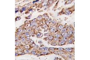 IHC analysis of FFPE human lung carcinoma tissue stained with LAMP1 antibody (LAMP1 antibody  (AA 125-154))
