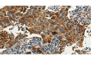 Immunohistochemistry of paraffin-embedded Human lung cancer using SERPINA9 Polyclonal Antibody at dilution of 1:60 (SERPINA9 antibody)