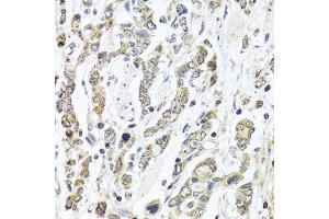 Immunohistochemistry of paraffin-embedded human gastric cancer using IFNL3 antibody (ABIN6293714) at dilution of 1:100 (40x lens). (IL28B antibody)