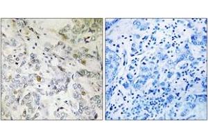 Immunohistochemistry analysis of paraffin-embedded human breast carcinoma tissue, using HCC1 Antibody. (RBM39 antibody  (AA 147-196))