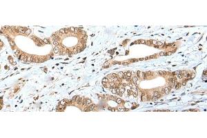 Immunohistochemistry of paraffin-embedded Human gastric cancer tissue using SPCS2 Polyclonal Antibody at dilution of 1:40(x200) (SPCS2 antibody)