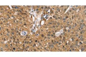 Immunohistochemistry of paraffin-embedded Human breast cancer using SORT1 Polyclonal Antibody at dilution of 1:35 (Sortilin 1 antibody)