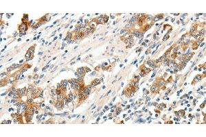 Immunohistochemistry of paraffin-embedded Human gastric cancer tissue using SCN9A Polyclonal Antibody at dilution 1:40 (SCN9A antibody)