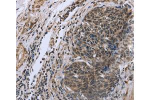 Immunohistochemistry of Human ovarian cancer using FANCG Polyclonal Antibody at dilution of 1:50