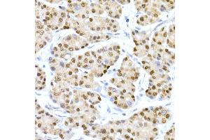 Immunohistochemistry of paraffin-embedded human liver cancer using HNF-4-alpha Rabbit mAb (ABIN7267621) at dilution of 1:150 (40x lens).