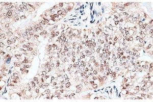 Immunohistochemistry of paraffin-embedded Human endometrium cancer using RBM3 Polyclonal Antibody at dilution of 1:100 (40x lens).