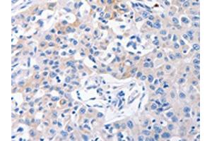 The image on the left is immunohistochemistry of paraffin-embedded Human lung cancer tissue using ABIN7192382(SLC10A1 Antibody) at dilution 1/31, on the right is treated with synthetic peptide. (SLC1A1 antibody)