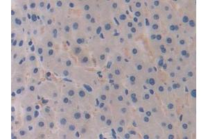 Detection of BRCA1 in Human Liver cancer Tissue using Polyclonal Antibody to Breast Cancer Susceptibility Protein 1 (BRCA1) (BRCA1 antibody  (AA 19-83))