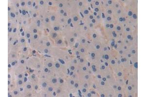 Detection of BRCA1 in Human Liver cancer Tissue using Polyclonal Antibody to Breast Cancer Susceptibility Protein 1 (BRCA1)