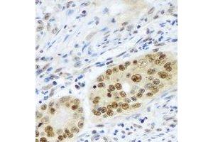 Immunohistochemical analysis of PSMB2 staining in human colon cancer formalin fixed paraffin embedded tissue section.