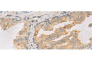 Immunohistochemistry of paraffin-embedded Human prost ate cancer tissue using ANXA13 Polyclonal Antibody at dilution of 1:105(x200) (Annexin A13 antibody)