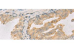 Immunohistochemistry of paraffin-embedded Human prost ate cancer tissue using ANXA13 Polyclonal Antibody at dilution of 1:105(x200) (Annexin A13 antibody)