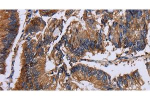 Immunohistochemistry of paraffin-embedded Human colon cancer using KRT31 Polyclonal Antibody at dilution of 1:30 (Keratin 31 antibody)