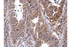 IHC-P Image Annexin VII antibody detects Annexin VII protein at cytosol on human gastric carcinoma by immunohistochemical analysis.