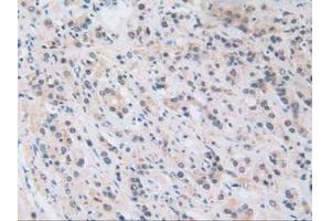 IHC-P analysis of Human Prostate Gland Cancer Tissue, with DAB staining. (NUP50 antibody  (AA 37-269))