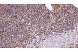 ABIN6273136 at 1/100 staining Human lymph cancer tissue by IHC-P. (DIAPH1 antibody)