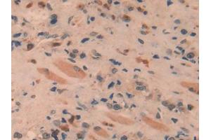 DAB staining on IHC-P; Samples: Human Prostate cancer Tissue (SPRY1 antibody  (AA 118-309))