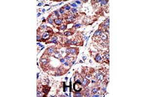Formalin-fixed and paraffin-embedded human hepatocellular carcinoma tissue reacted with SQSTM1 polyclonal antibody  , which was peroxidase-conjugated to the secondary antibody, followed by DAB staining. (SQSTM1 antibody  (C-Term))