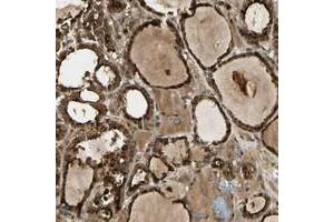 Immunohistochemical staining of human thyroid gland with GMEB2 polyclonal antibody  shows strong nuclear and cytoplasmic positivity in glandular cells at 1:20-1:50 dilution. (GMEB2 antibody)