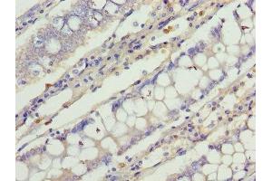 Immunohistochemistry of paraffin-embedded human colon cancer using ABIN7147039 at dilution of 1:100 (Cation Channel Sperm-Associated Protein Subunit epsilon (CATSPERE) (AA 601-832) antibody)