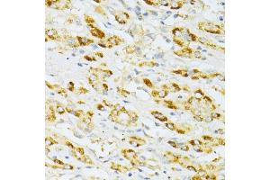 Immunohistochemistry of paraffin-embedded human liver cancer using FLT3 antibody (ABIN6134576, ABIN6140691, ABIN6140694 and ABIN6216061) at dilution of 1:100 (40x lens).