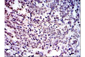 Immunohistochemical analysis of paraffin-embedded human cervical cancer tissues using NEDD8 monoclonal antibody, clone 1A7  with DAB staining. (NEDD8 antibody)
