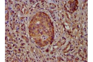 IHC image of ABIN7169106 diluted at 1:100 and staining in paraffin-embedded human pancreatic cancer performed on a Leica BondTM system. (NEK5 antibody  (AA 372-468))