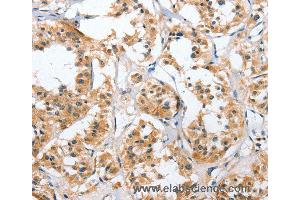 Immunohistochemistry of Human thyroid cancer using UGCG Polyclonal Antibody at dilution of 1:50