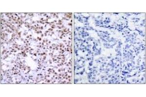 Immunohistochemistry analysis of paraffin-embedded human breast carcinoma, using Chk2 (Ab-68) Antibody. (CHEK2 antibody  (AA 35-84))