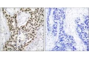 Immunohistochemistry analysis of paraffin-embedded human prostate carcinoma, using Androgen Receptor (Phospho-Ser213) Antibody. (Androgen Receptor antibody  (pSer213))