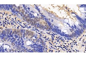 Detection of EIF4EBP1 in Human Colorectal cancer Tissue using Polyclonal Antibody to Eukaryotic Translation Initiation Factor 4E Binding Protein 1 (EIF4EBP1) (eIF4EBP1 antibody  (AA 2-118))