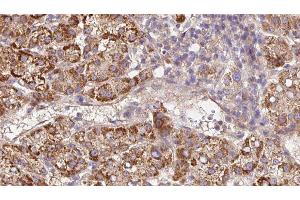 ABIN6279672 at 1/100 staining Human liver cancer tissue by IHC-P.