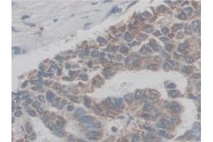 Detection of CF6 in Human Liver cancer Tissue using Polyclonal Antibody to Coupling Factor 6 (CF6) (ATP5J antibody  (AA 1-108))