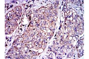 Immunohistochemical analysis of paraffin-embedded lung cancer tissues using SERPINE1 mouse mAb with DAB staining. (PAI1 antibody)
