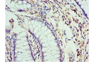 Immunohistochemistry of paraffin-embedded human colon cancer using ABIN7151101 at dilution of 1:100 (Pellino 1 antibody  (AA 1-250))