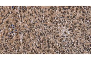 Immunohistochemistry of paraffin-embedded Human lung cancer tissue using DLX4 Polyclonal Antibody at dilution 1:50 (DLX4 antibody)