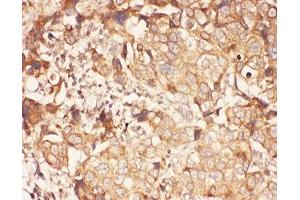 IHC-P: ALOX15 antibody testing of human breast cancer tissue (ALOX15 antibody  (AA 2-337))