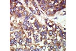 IHC analysis of FFPE human hepatocarcinoma tissue stained with the PAK2 antibody (PAK2 antibody  (AA 192-222))