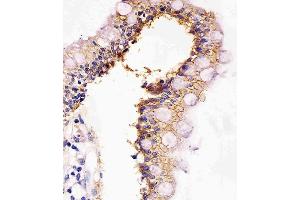 (ABIN6242350 and ABIN6577163) staining CADH1 in human colon tissue sections by Immunohistochemistry (IHC-P - paraformaldehyde-fixed, paraffin-embedded sections). (E-cadherin antibody  (AA 1-392))