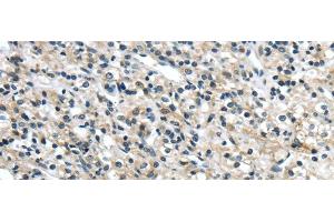 Immunohistochemistry of paraffin-embedded Human prostate cancer tissue using GRIN2A Polyclonal Antibody at dilution 1:35 (NMDAR2A antibody)
